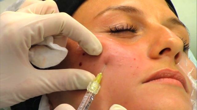 Pluryal | Биоармирование лица смотреть онлайн