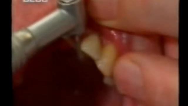 Лекция №1 Бюгельные протезы 1 смотреть онлайн