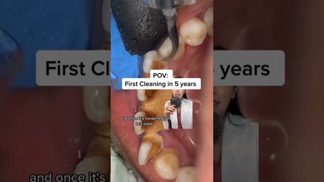 When a patient hasnt gotten a cleaning in a while,plaque can calcify into tarta | Dentistry Explain смотреть онлайн
