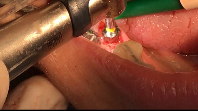 Навігаційний шаблон для системи імплантів Ankylos / Surgical Guide for Ankylos Implant смотреть онлайн