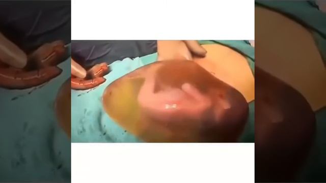 Baby borned in placenta | Baby in amniotic sac intact | New born | New baby | смотреть онлайн