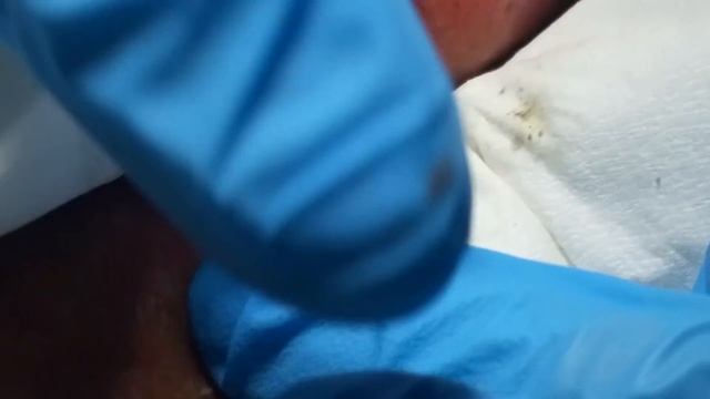 Giant Blackheads  - Part I -