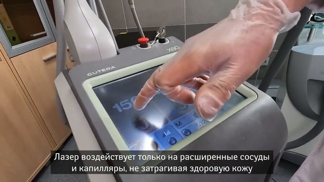 Современный лазерный метод лечения сосудистых звездочек смотреть онлайн