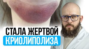 СТРАШНЫЕ ПОСЛЕДСТВИЯ КРИОЛИПОЛИЗ. Криолиполиз до и после отзывы