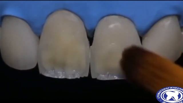 Наращивание зубов с восстановлением эстетики смотреть онлайн