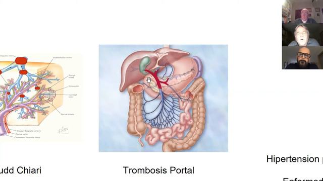 La trombosis portal,síndrome de Budd-Chiari y las NMP-MPN смотреть онлайн