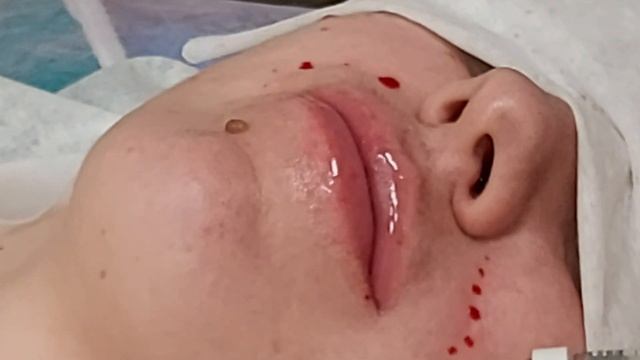 Заполнение носогубной складки филлером.