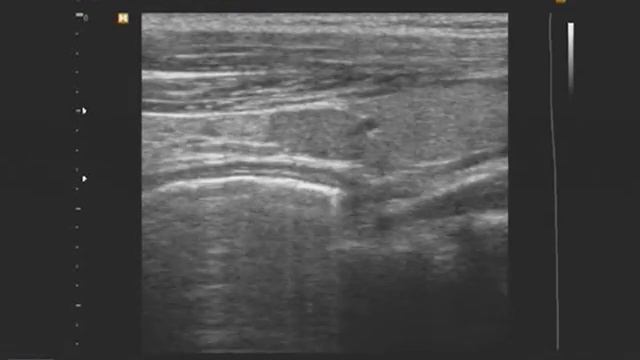 Видеозапись УЗИ - Добавочная овальная долька нижнего полюса левой доли щитовидной железы смотреть онлайн