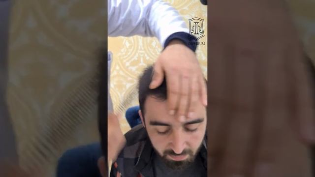 Отзыв пациента после пересадки волос 3000 Графтов