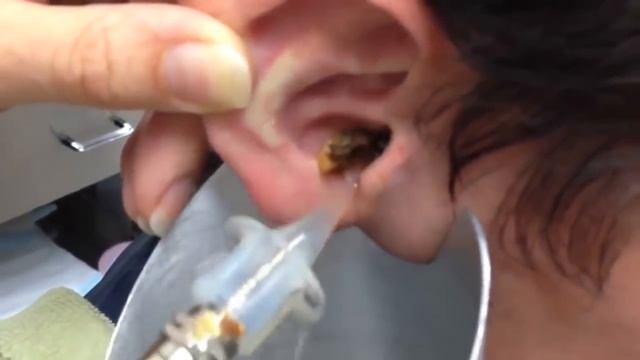 Вымывание огромной серной пробки из уха | Как вымывается серная пробка? смотреть онлайн