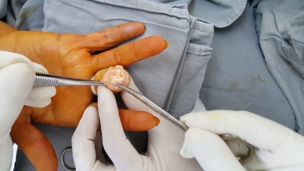 Amputação de Dedo da Mão