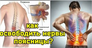 Сдавливание поясничного нерва L4 вызывает деградацию мышц ног и дисфункцию предстательной железы.