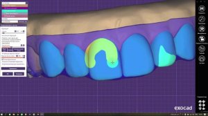 15. Моделирование шаблона для коррекции десны