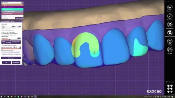 15. Моделирование шаблона для коррекции десны