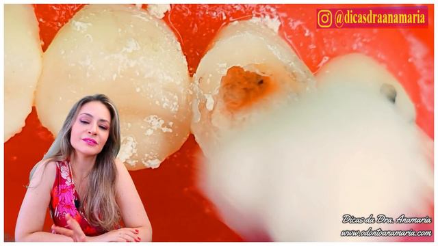 INCRÍVEL: Tratamento de Canal + Pino intra-radicular + Coroa de Resina em 4K! смотреть онлайн