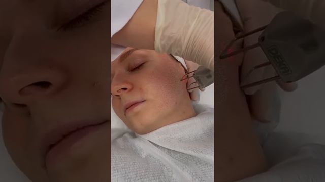 Лазерный пилинг | Фракционное лазерное омоложение смотреть онлайн