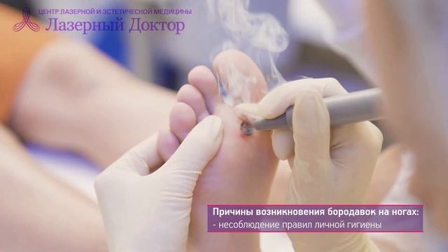 Подошвенная бородавка