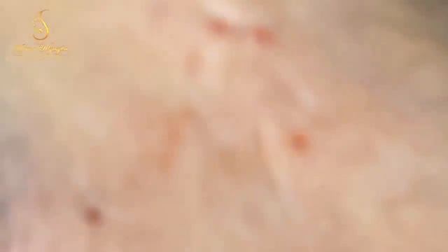 Blackhead Removal With Sac Dep Spa @1000248