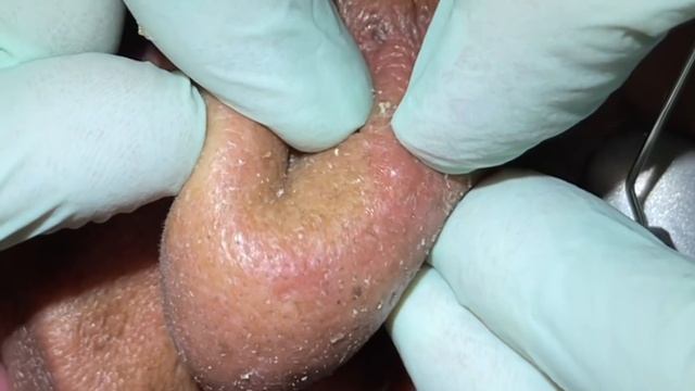 Nose extractions. Blackheads. Whiteheads . DPOW. Pore dirt cleared. Pop talk. Fun patient. MrPopZit смотреть онлайн