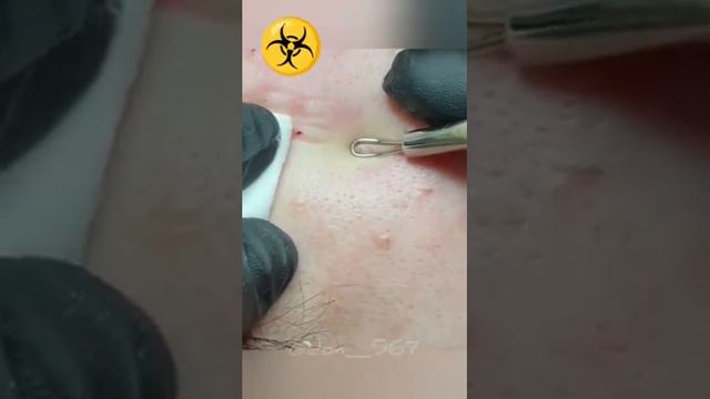 Выдавливание прыщей смотреть онлайн