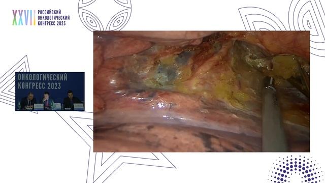 Торакоабдоминальная онкохирургия. Видеострим. Часть 1 смотреть онлайн