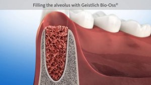 Что делать после удаления зуба? Видео для пациентов (ENG)