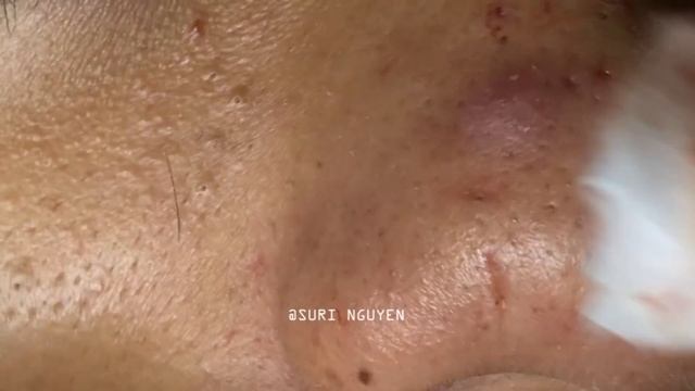 Suri 49: AWESOME BLACKHEADS ON NOSE смотреть онлайн