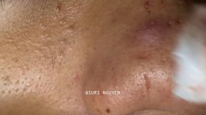 Suri 49: AWESOME BLACKHEADS ON NOSE