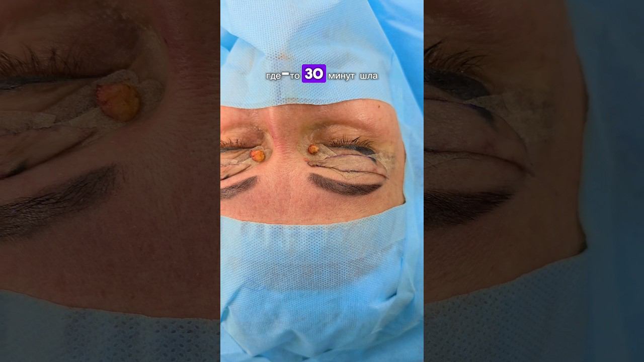 всего то 30 мин , а какой результат)  #пластическийхирург #пластика #блефаропластика