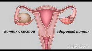 Психосоматика киста яичника