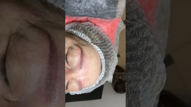 Удаление ремувером старого татуажа смотреть онлайн