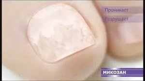 Реклама Микозан: Микозан о грибка ногтей