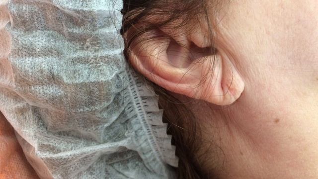 Урок красоты 20. Контурная пластика мочек ушей смотреть онлайн