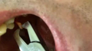 Удаление зуба в домашних условиях