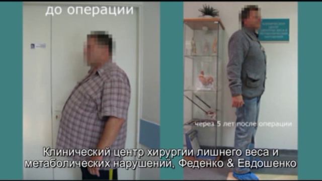 бандажирование желудка, через 5 лет смотреть онлайн