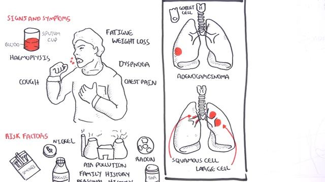 Lung Cancer - Overview смотреть онлайн