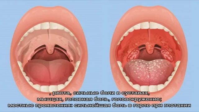 Чем отличается фарингит от ангины смотреть онлайн