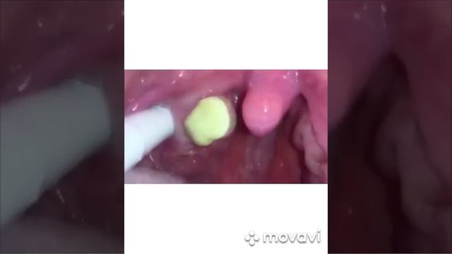 Гной в горле?!