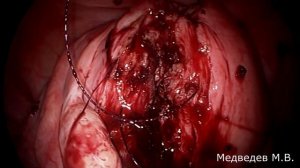 Лапароскопическая миомэктомия при субмукозной миоме