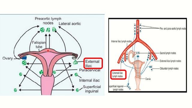 Lymphatics of uterus MRCS question solve (CRACK MRCS) смотреть онлайн