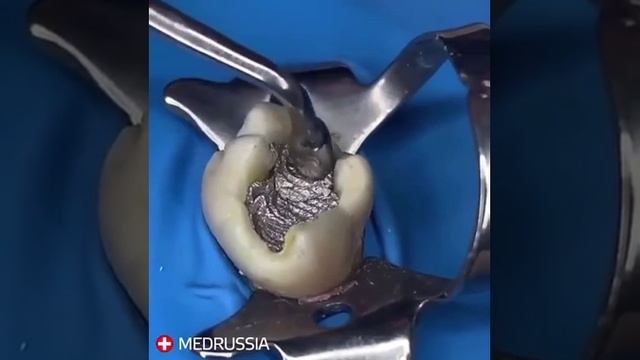 Амальгамовая пломба смотреть онлайн