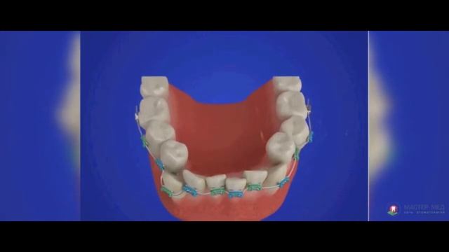 Брекеты во взрослом возрасте. Стоит ли устанавливать?