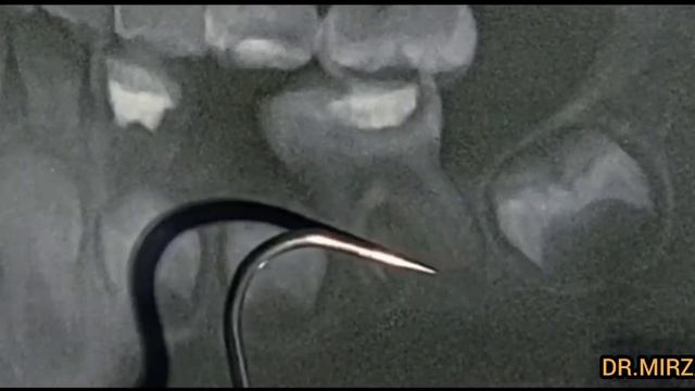 Тисти жулуга болмайды неге? Тис ауруы тис жулу