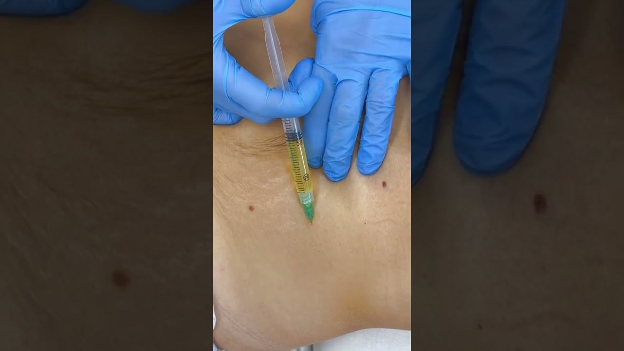 #Плазмолифтинг - первый этап лечения растяжек #растяжки смотреть онлайн