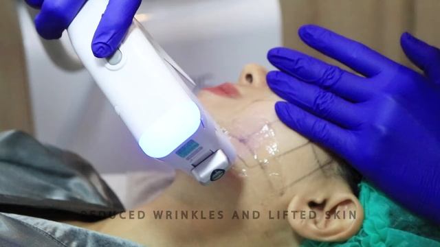 MAHARVA Double Layer Lift Treatment (HIFU)