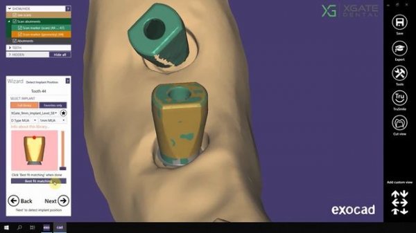 Exocad tutorial | How to use ExoCad library - Model on straight D-type multiunits without sleeve