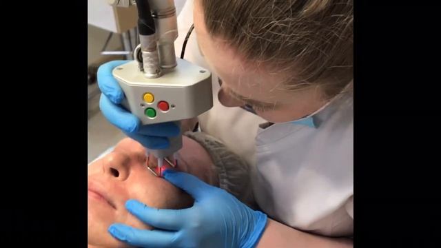 Медицина не стоит на месте. Удаление пигментов и лазерная шлифовка лица на аппарате Deka смотреть онлайн