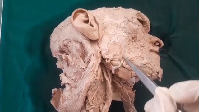 Submandibular Region-Dissection submandibular & Sublingual gland, muscles & important nerves смотреть онлайн
