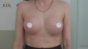 Увеличение груди. Сумбамарный  доступ (под грудью).