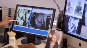 Разрыв крестообразной коленной связки